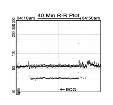 Image of a 40 Minute R-R Plot showing a sinus arrhythmia